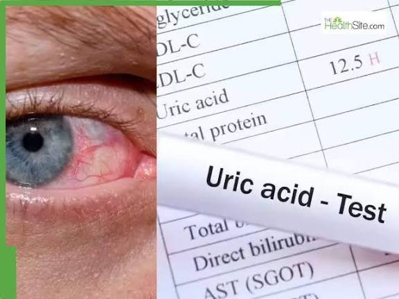 शरीर में हाई यूरिक एसिड का लेवल आंखों के स्वास्थ्य के लिए बड़ा खतरा, जानें इसके लक्षण और कारण