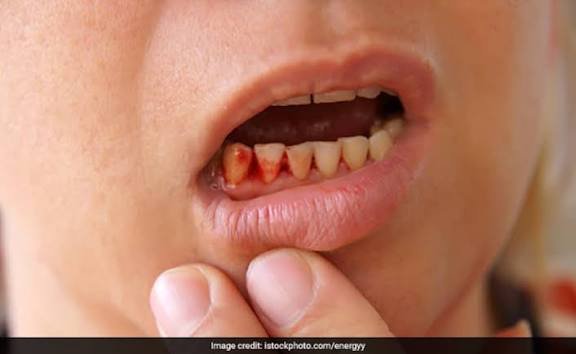 मसूड़ों से खून आना दिल की बीमारी का संकेत है, क्या आप जानते हैं कि इन दोनों के बीच क्या है कनेक्श